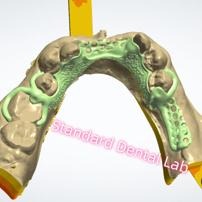 acheter Conception de cadre métallique Impression au laser Dentition partielle en chrome coulé Ni être libre fabrication en ligne