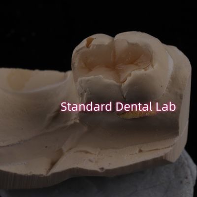 acheter Porcelaine en fonte incrustation dentaire incrustation surplacement zirconia Emax haute esthétique fabrication en ligne
