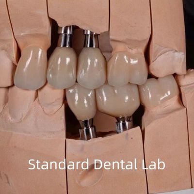 acheter Une couronne d'implant en zirconium à vis esthétique naturelle fabrication en ligne