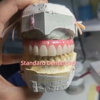 acheter Titane PMMA à vis retenue pont dentaire couronne temporaire fabrication en ligne