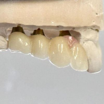 acheter Porcelaine Zirconia Ciment Implanté à vis retenue Forme de tête hexagonale pour une esthétique personnalisée fabrication en ligne