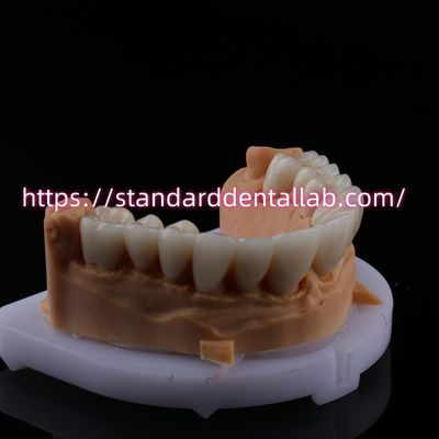 acheter FDA haute esthétique pont dentaire en zirconium avec couronne dentaire en porcelaine en zirconium en Chine Laboratoire dentaire fabrication en ligne