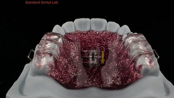 acheter Expansion et distillation des dents ajustement d' un expansateur dans la bouche d' un orthodontiste d' un expansateur de palais fabrication en ligne