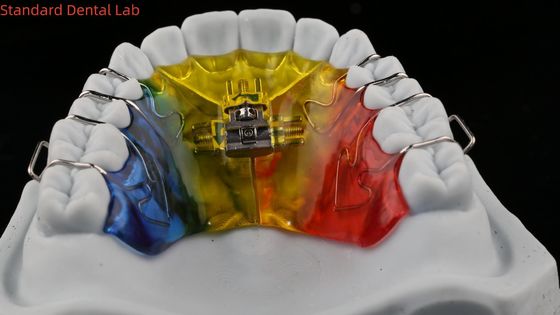 acheter Expansion et distillation des dents Orthodontiste du palais expansateur laboratoire dentaire chinois fabrication en ligne