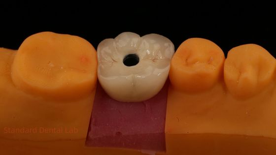acheter Croix d'implant dentaire en zirconium en porcelaine PFZ à vis retenu du laboratoire dentaire certifié ISO FDA CE avec garantie de 5 ans fabrication en ligne
