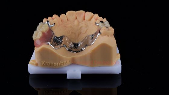 acheter Dentures en cobalt chrome partielles Ivoclar Scheftner cadre métallique confortable livré en seulement 3 jours fabrication en ligne