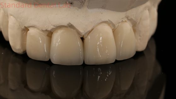 acheter Une couronne et un pont en zirconium à couches solides en bonne esthétique fabrication en ligne