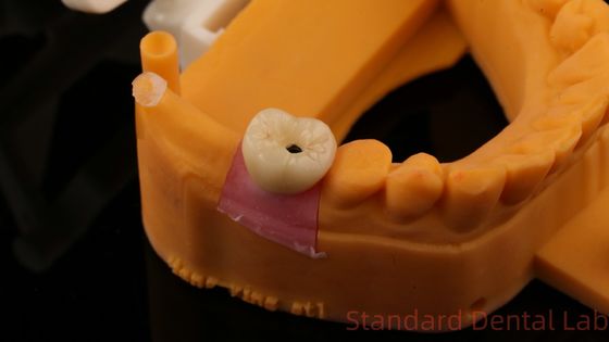acheter Écrou d'implant dentaire couronne retenue PFZ Porcelaine en acier à couches avec modèle d'impression 3D fabrication en ligne