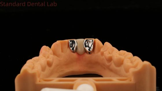 acheter Dentiste PFM Maryland Bridge haute esthétique certifié par la FDA avec Vita Porcelian China Dental Lab fabrication en ligne