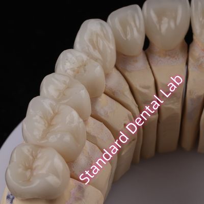 Laboratoire dentaire numérique CAD CAM PFZ Couronnes translucides à couches couronne de zirconia