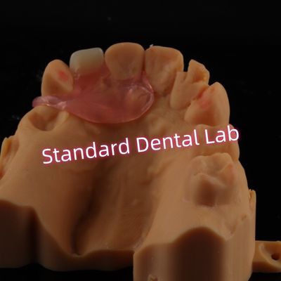 Prothèses dentaires unilatérales supérieures à valplastes amovibles flexibles à une dent