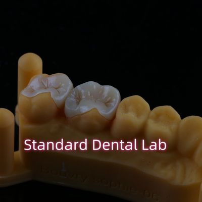 Résine composite Zirconia Emax métal incrusté Onlay Overlay