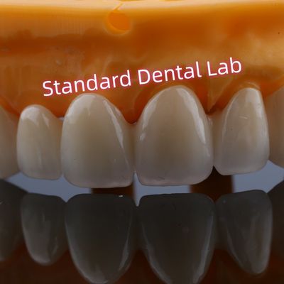 Restauration de l'avant des couronnes de pont en zirconium pour les dents manquantes