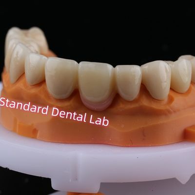 La couronne de pont en zirconium couche avec porcelaine rose