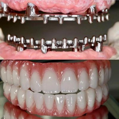 Dental Hybrid Malo Implant Bridge professionnel en parfait ajustement certifié FDA