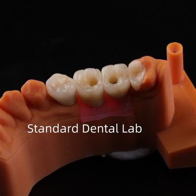Porcelaine Zirconia pont d'implant dentaire professionnel haute esthétique