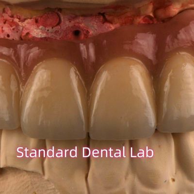 CAD CAM Fraisage PFM Porcelaine non précieuse fondue dans le métal