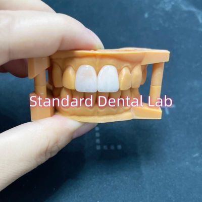 Stabilité de la couleur élevée Ivoclar Emax Veneurs stratifiés Haute translucide