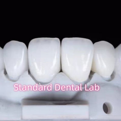 Restaurations à l' apparence naturelle Dentistique à l' aide de la couronne dentaire en zirconium