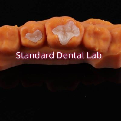Porcelaine dentaire en incrustation en recouvrement en zirconium émax composite pour les carie dentaire
