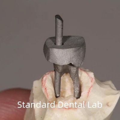Restauration dentaire Poteaux métalliques et couronne de noyau parfaitement ajustés