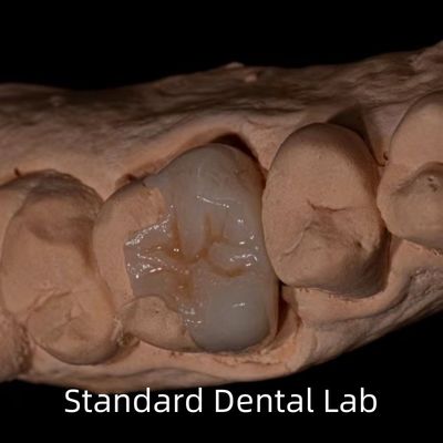 Translucide Emax Zirconia Dental Inlay Onlay Couronne pour rétablir la forme naturelle de la cavité