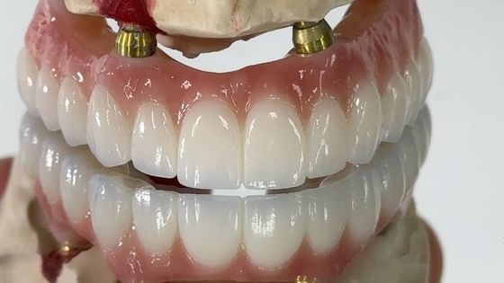 Dentistique tout sur X Implant PFM Couronne Titane Fixée Hybride Prothèse