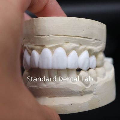 Des couronnes dentaires pour le diagnostic, la cirée esthétique, du laboratoire dentaire chinois.