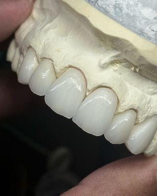 Couronne en zirconium à couches translucides pour une fonctionnalité optimale et une esthétique naturelle