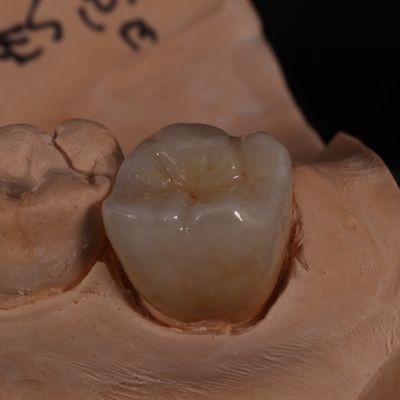 Couronne de zirconium translucide à contour complet pour des résultats esthétiques