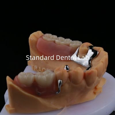 Métal allié cadre de prothèse partielle 3 forme Exocad Impression au laser finition partielle en fonte inférieure