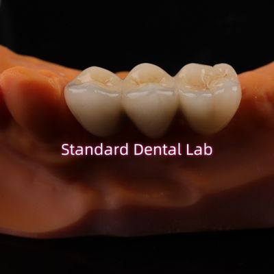 Couronnes de laboratoire dentaire numérique CAD CAM Translucide couronne en zirconium en couches