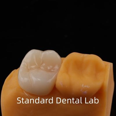 5 ans de garantie couronne de zirconie pour les molars Noritake Porcelaine fabriquée par un laboratoire dentaire de confiance
