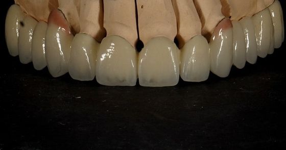 Bon ajustement Bonne esthétique Couronne en zirconium à plusieurs couches Porcelaine Pont en zirconium