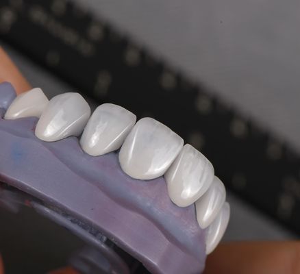 L'apparence naturelle des facettes Emax Couronne Biocompatibilité Tonne de blanchiment avec une préparation minimale