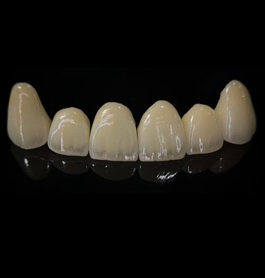 Une couronne de zirconium confortable avec un bon ajustement et une esthétique précise
