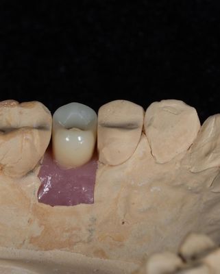 Implant à vis en ciment pour les implants dentaires à longue durée de vie avec garantie de 5 ans