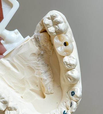 Ciment à vis Implant retenu Implant poli Porcelain supporté Pont à pleine voûte