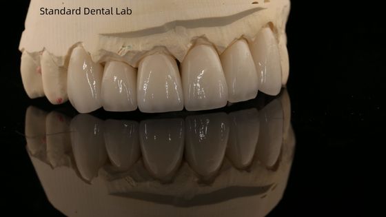 Une couronne en zirconium et un pont dentaire naturel esthétique 5 ans de garantie