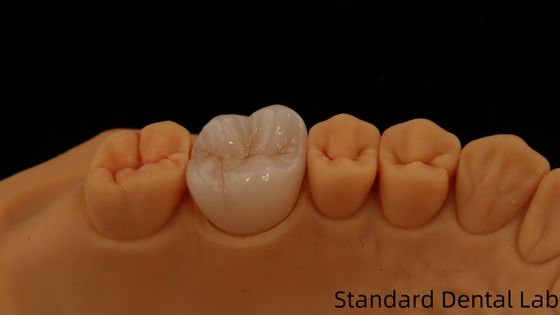 Noritake Porcelaine de contour complet couronne de zirconium personnalisée Vita Shade pour la restauration dentaire numérique esthétique par le laboratoire dentaire