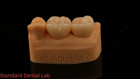 Des couronnes de laboratoire dentaire 3D Pro haute translucide couronnes en zirconium complet avec garantie de 5 ans