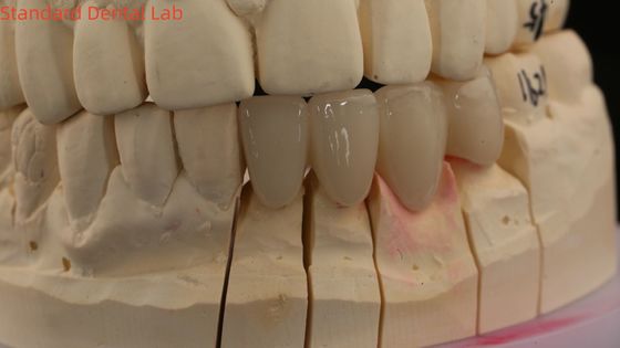 Des couronnes de laboratoire dentaire 3D Pro haute translucide couronnes en zirconium complet avec teinte vita personnalisée