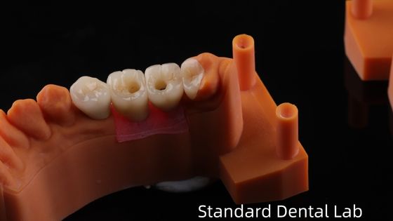 Couronne d'implant dentaire à vis avec PFZ Porcelaine en Zirconia en couche Garantie de 5 ans et modèle d'impression 3D