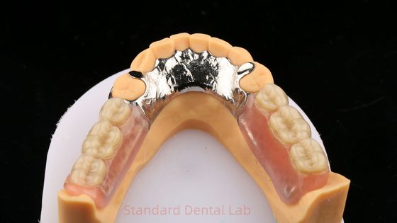 Métal alliages Cobalt chrome Prothèse partielle Ivoclar Scheftner Confortable cadre en métal moulé