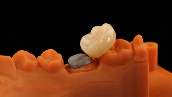 Une couronne en zirconium à contour complet et métallique avec une garantie de 5 ans et de meilleurs techniciens du laboratoire dentaire SDL