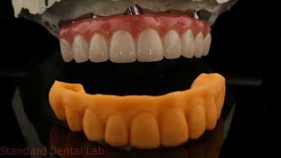 5 ans de garantie Implantation dentaire couronne PMMA pont sur plusieurs unités abutments personnalisé Vita Shade