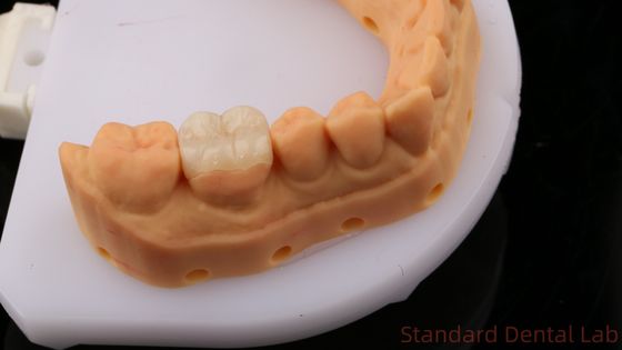 Inlay dentaire en zirconium translucide couronne onlay pour restaurer la forme naturelle de la cavité / laboratoire dentaire standard