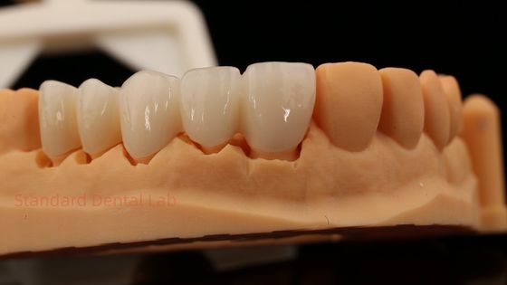 Des dents antérieures de haute esthétique à contour complet couronne de zirconium avec laboratoire dentaire Vita Shade personnalisé