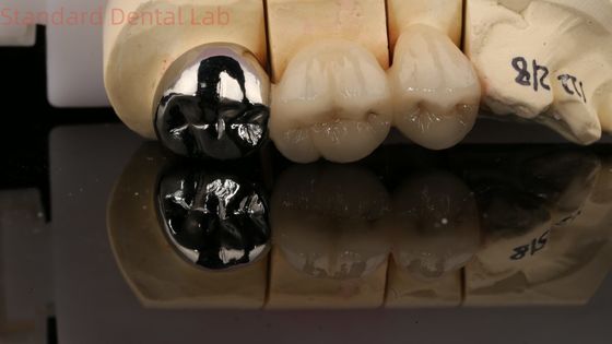 Une couronne en porcelaine vitale en métal complet avec un noyau postérieur 3 ans de garantie du laboratoire dentaire