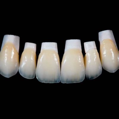 Une couronne de facettes de porcelaine Emax à haute translucide avec de meilleurs matériaux par Ivoclar Vivadent